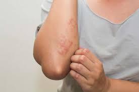 Skin Rashes: Causes, Prevention and Solutions